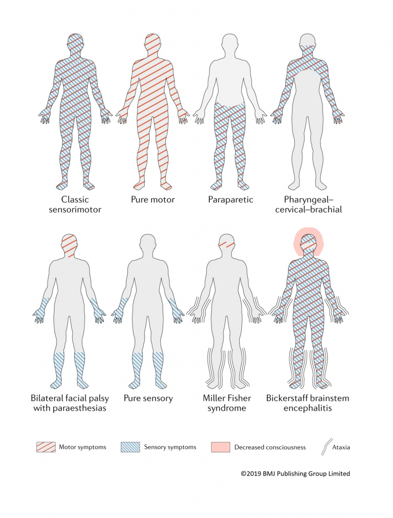 GBS & Associated Acute Inflammatory Neuropathies - GAIN