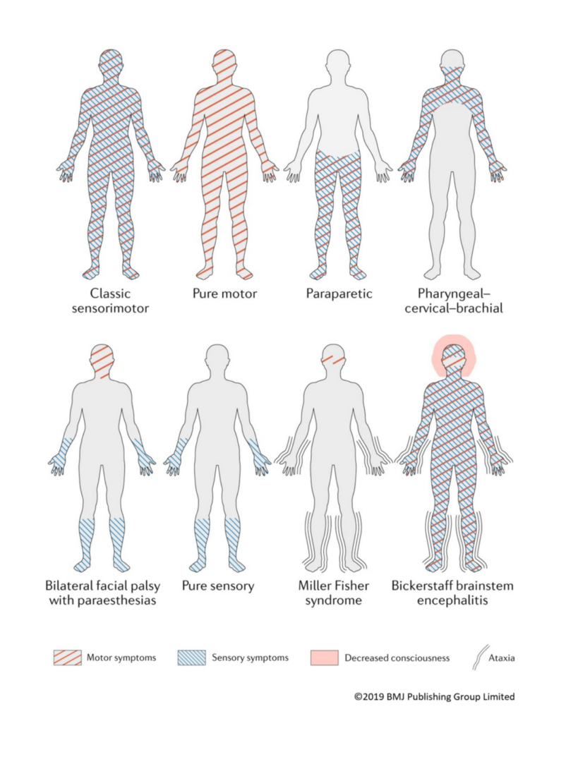 GBS & associated acute inflammatory neuropathies - GAIN